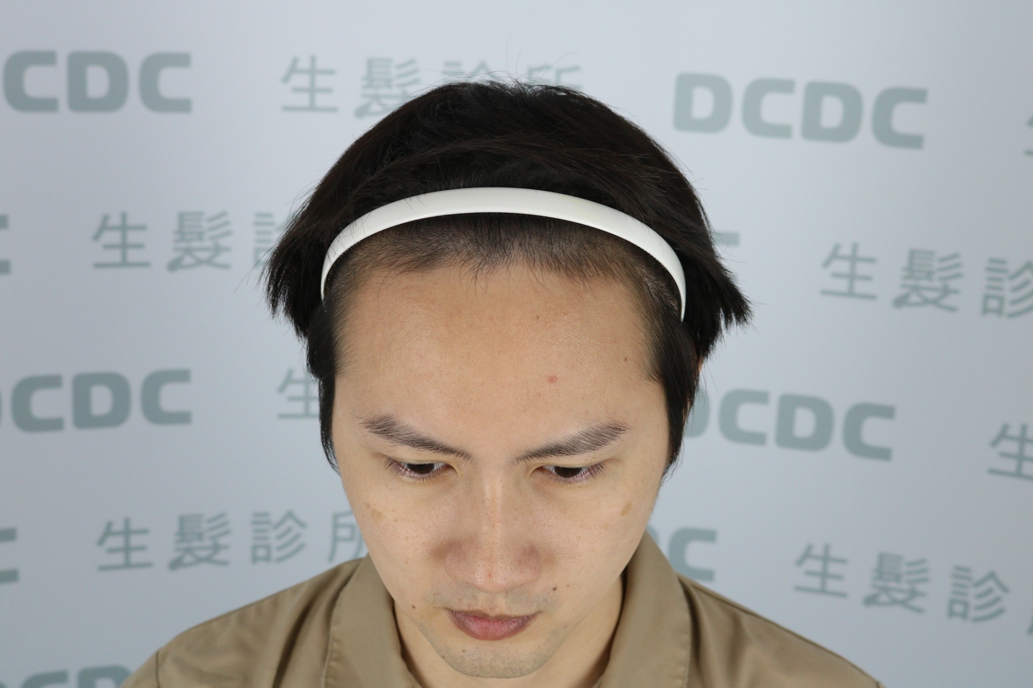 DCDC生髮診所-柯博桓醫師男性前額植髮手術當天設計規劃